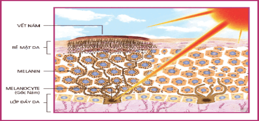 Các tác nhân bên trong và bên ngoài gây tàn nhang